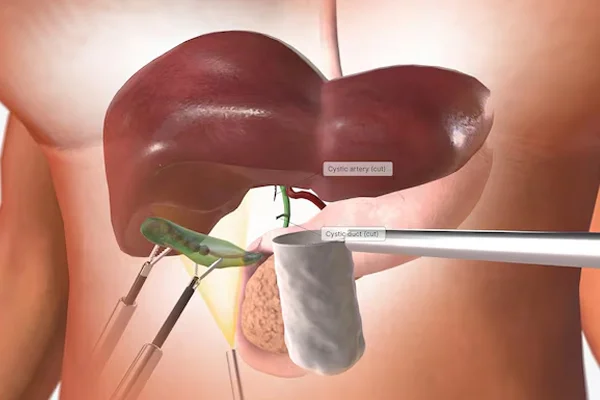 Gallbladder and Appendix Surgery