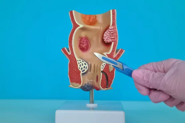 Piles Fistula and Fissure Surgery